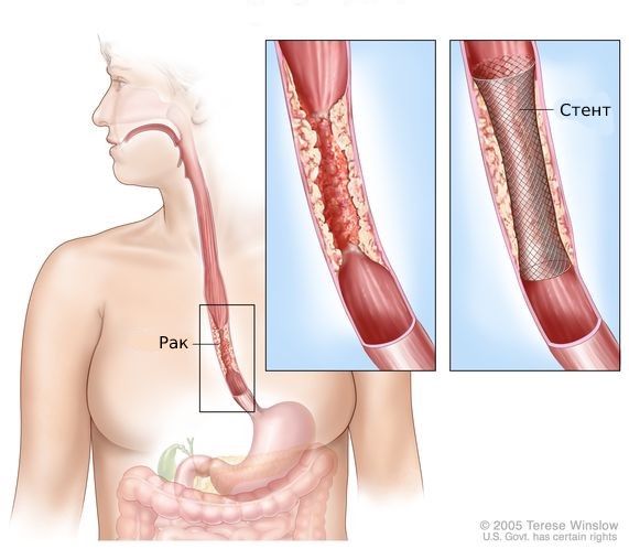 Стентирование пищевода 