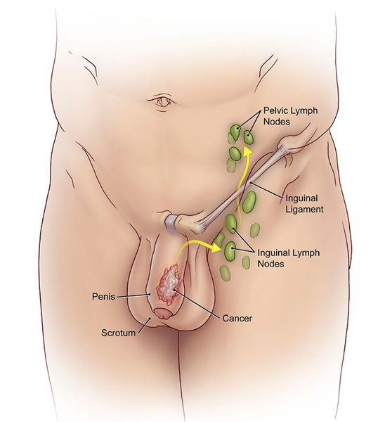 Лимфоузлы в паховой обсласти