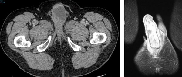 Рак полового члена на снимках КТ и МРТ