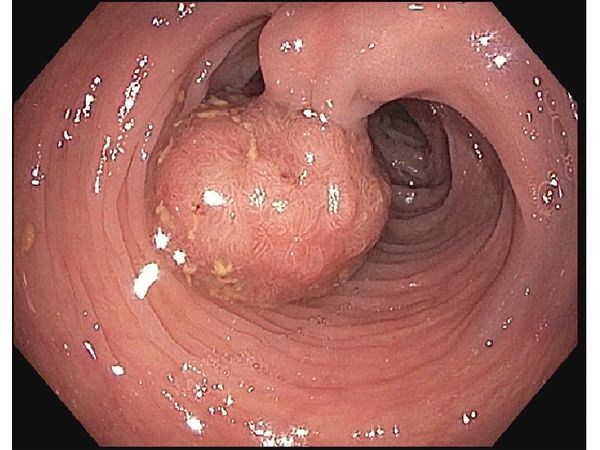 Полип на длинной ножке в нисходящем отделе толстой кишки