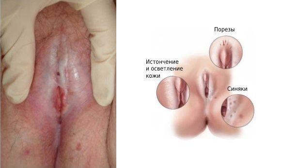 Склероатрофический лишай