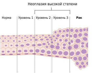 Вульварная интраэпителтальная неоплазия