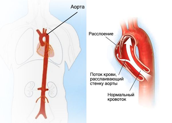 Расслоение аорты