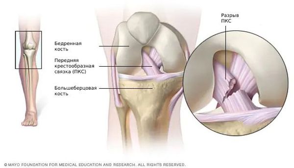 Разрыв передней крестообразной связки 