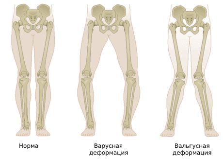 Деформация коленного сустава