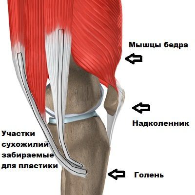 Участки сухожилий, используемые для пластики