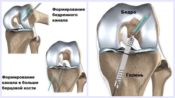 Формирование каналов в костях и проведение трансплантата