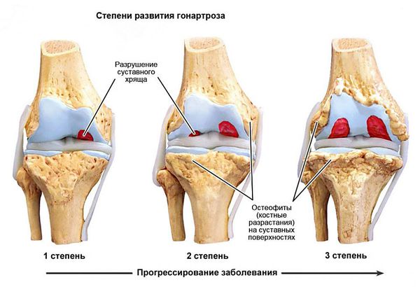 Гонартроз