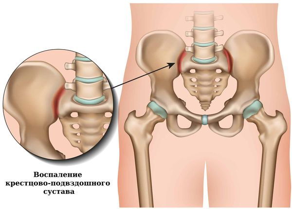 Воспаление крестцово-подвздошных суставов