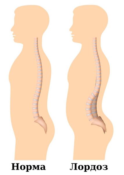 Здоровый позвоночник и лордоз