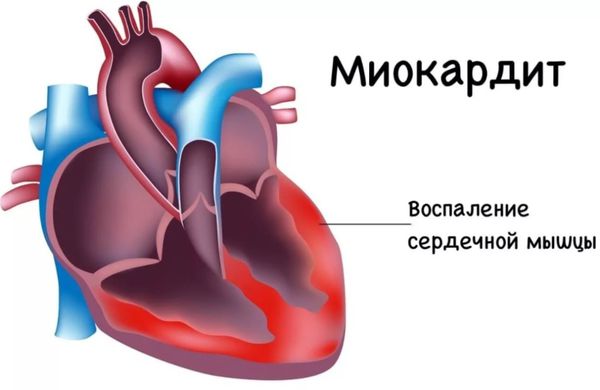 Миокардит