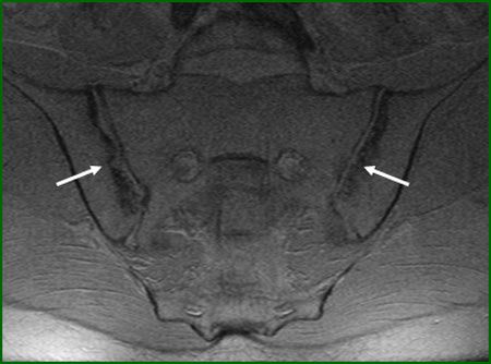 Двусторонний сакроилеит. Стрелками указаны эрозии обоих суставов 