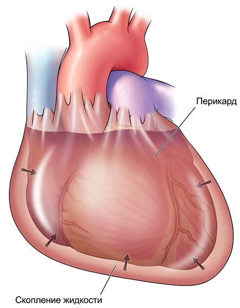 Тампонада сердца