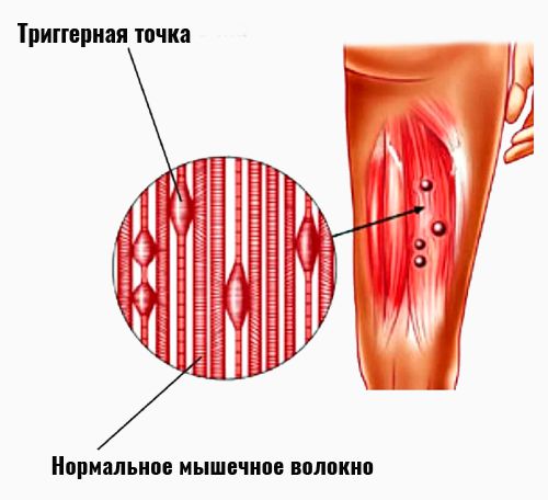 Триггерная точка