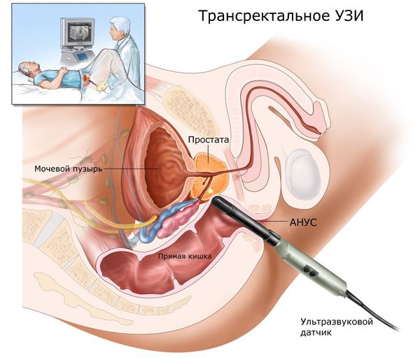 Трансректальное УЗИ простаты