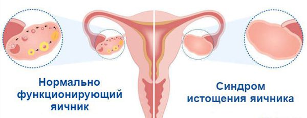 Отсутствие яйцеклеток при синдроме истощения яичников