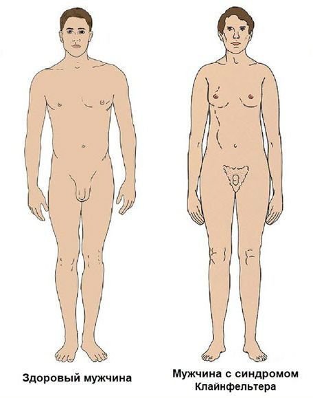 Здоровый мужчина и мужчина с синдромом Клайнфельтера