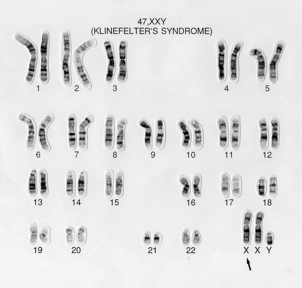 Кариотип при синдроме Клайнфельтера