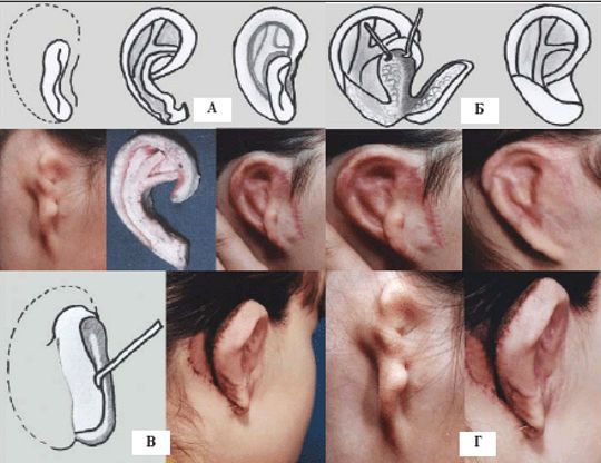 Отопластика при синдроме Конигсмарка