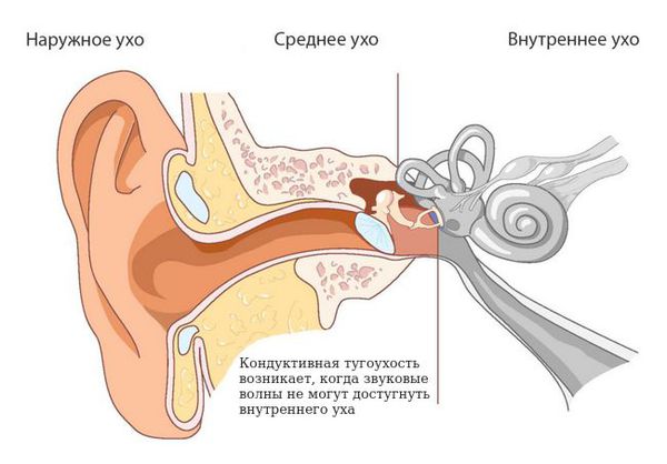 Кондуктивная тугоухость при синдроме Конигсмарка