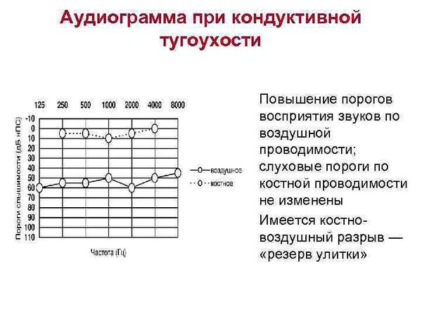 Аудиограмма при кондуктивной тугоухости