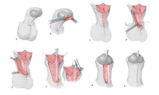Коррекция гипоспадии