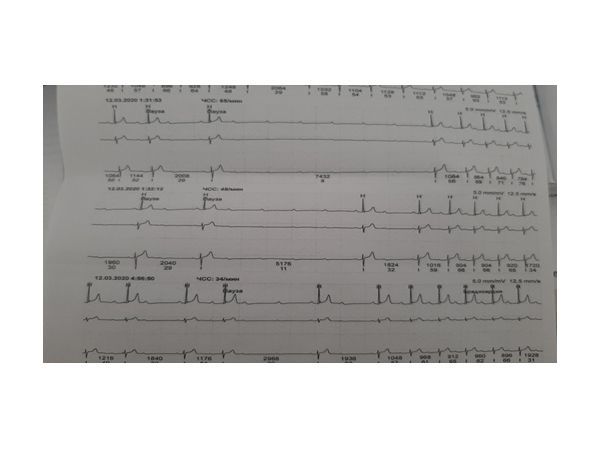 Фрагмент ХМЭКГ с паузами за счёт АВ блокады