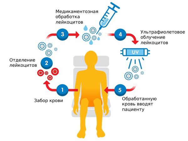 Экстракорпоральный фотоферез' data-blur='False