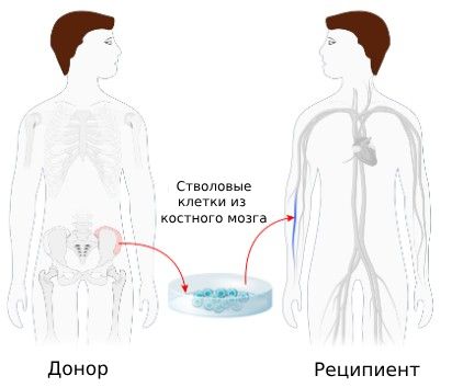 Трансплантация костного мозга' data-blur='False