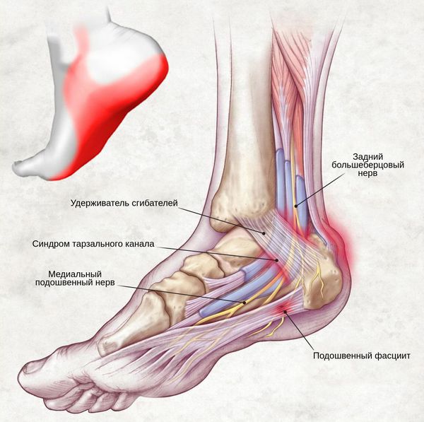 Боль при синдроме тарзального канала