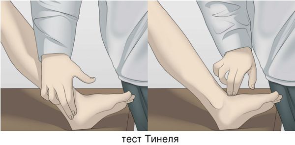 Тест Тинеля