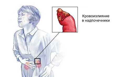 Синдром Уотерхауса — Фридериксена