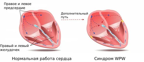 Синдром WPW' data-blur='False