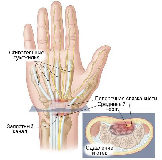 Запястный канал и сдавленный срединный нерв