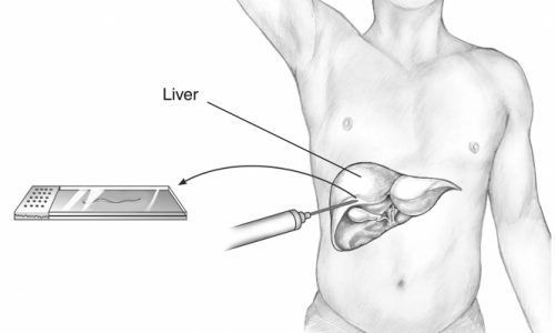 Пункция печени