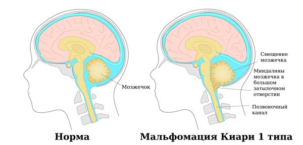 Мальфомация Киари 1 типа