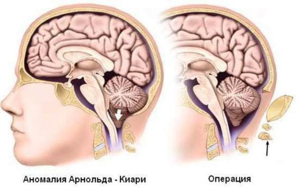 Декомпрессия задней черепной ямки и краниовертебрального перехода