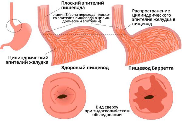 Пищевод Барретта