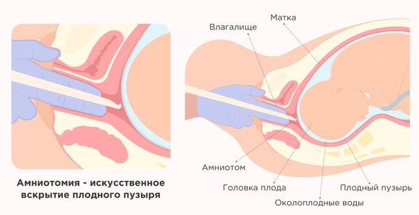 Амниотомия