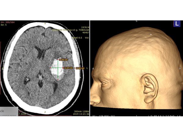 Измерение размеров внутримозговой гематомы