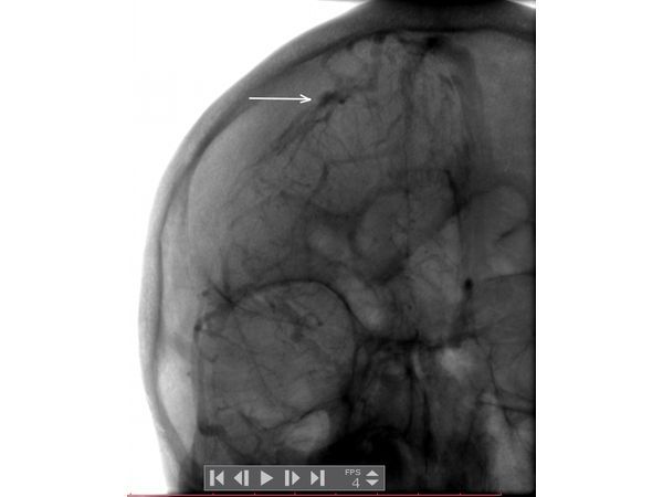 Сосудистая мальформация на ангиограмме правого полушария головного мозга