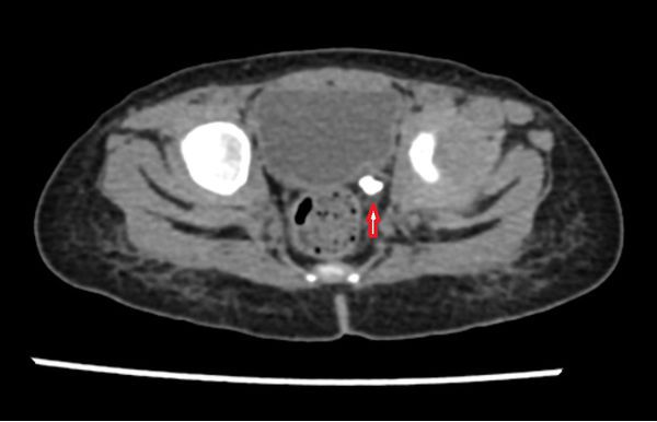 Компьютерная томография: конкремент левого мочеточника