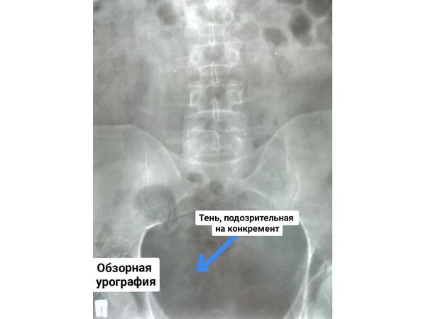 Обзорная урография: в проекции малого таза справа отмечается тень, подозрительная на конкремент, размерами 7*6 мм