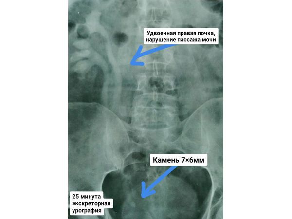 Экскреторная урография: удвоенная правая почка, уретерогидронефроз, гипотония мочеточника до уровня конкремента в нижней трети мочеточника