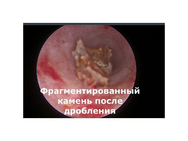 Проведение контактной пневматической литотрипсии