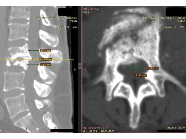 КТ поясничного отдела позвоночника до операции: измерение размеров позвоночного канала