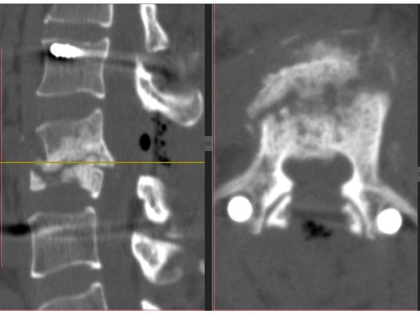 КТ поясничного отдела позвоночника после операции