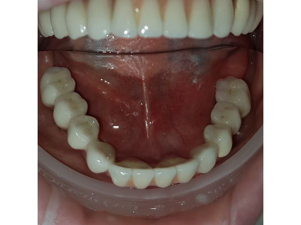 Установленный протез. Нижняя челюсть.