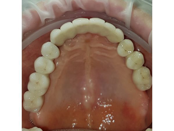 Установленный протез. Верхняя челюсть.
