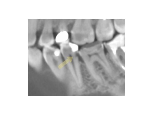 Скрытый кариес корня зуба 3.5 на снимке КТ